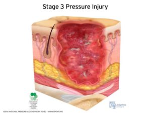 Assisted Living Facility Stage 3 Pressure Sore