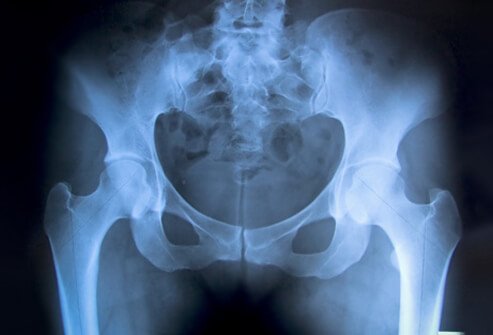Hip fracture from a nursing home fall