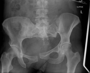 X-ray of Pelvic Fracture
