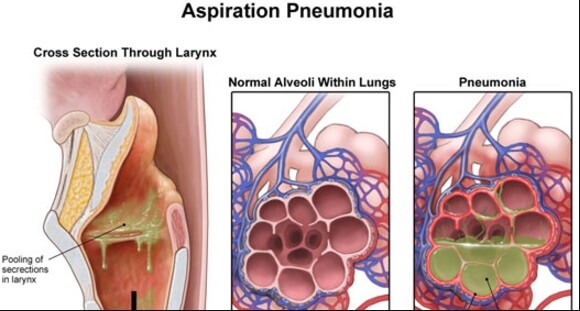 Aspiration pneumonia nursing home negligence lawsuit