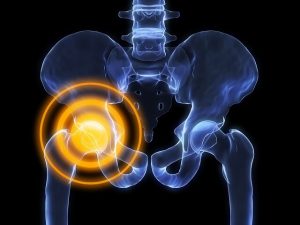 What is my Hip Fracture Case vs. Nursing Home Worth?