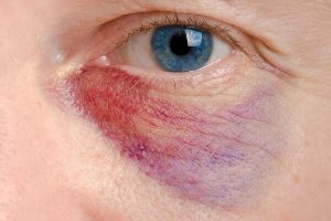 elderly lady with a black eye from another nursing home resident
