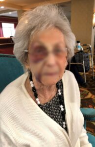 Elderly client neglected by her home health aide and suffered a fall resulting in bruising and a broken hip
