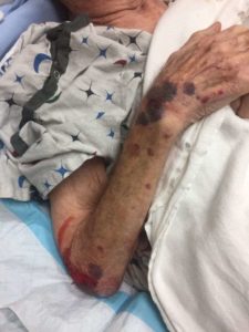 Hospital acquired injuries lead to patient neglect lawsuit