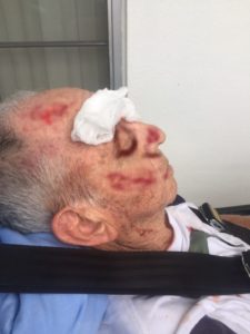 Patient fall in nursing home resulting in hematoma