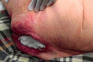 Deep stage 4 pressure sore with packing in the wound bed