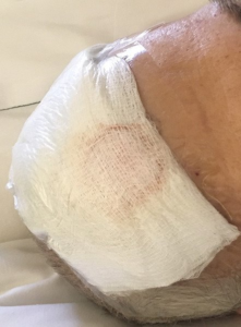 Bandages on a surgical site should be changed every day