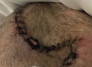 Infected surgical site due to nursing home staff not changing bandages