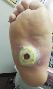 Nursing Home Diabetic Foot Ulcer Lawsuit