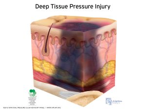 DTI pressure ulcer diagram