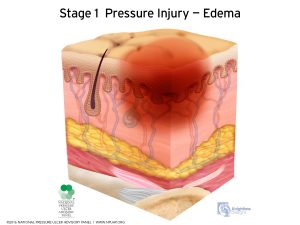 Stage 1 pressure ulcer in nursing home