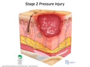 Stage II Pressure Injury Diagram