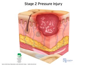 Bed Sore Cushions for Butt Positioning Pillow Pressure Ulcer