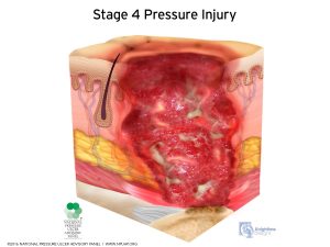 Stage IV Pressure Injury Diagram