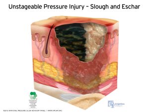Unstageable pressure injury picture