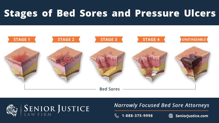 The Do's and Don'ts of Pressure Ulcers – NYC Bedsore Lawyer